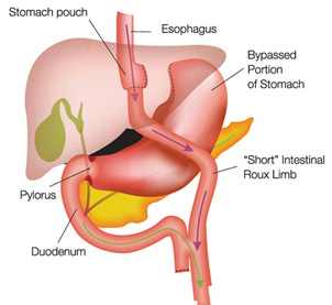 Gastric Bypass