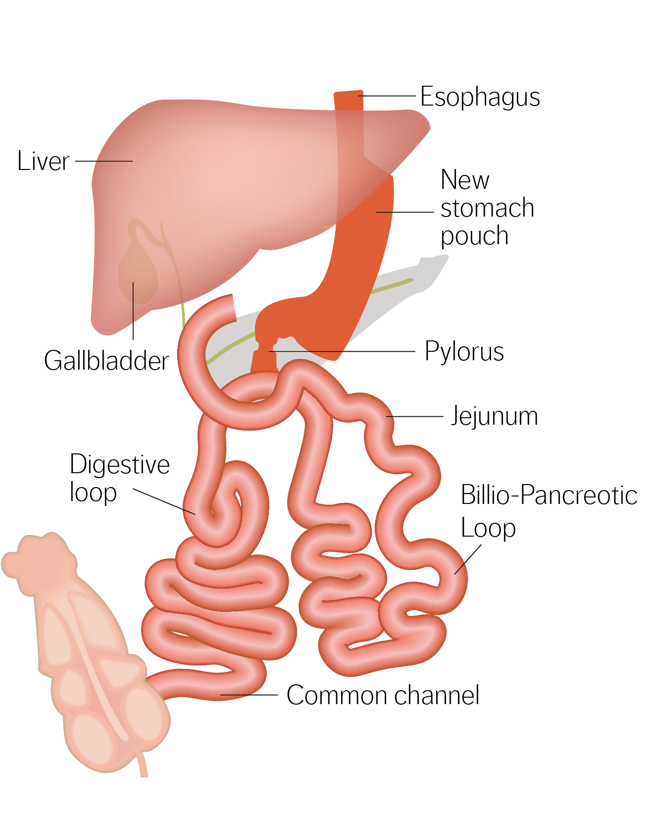 Modified Duodenal Switch